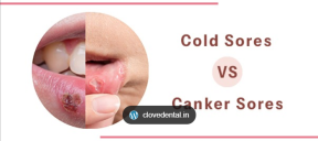 cold sore versus canker sore
